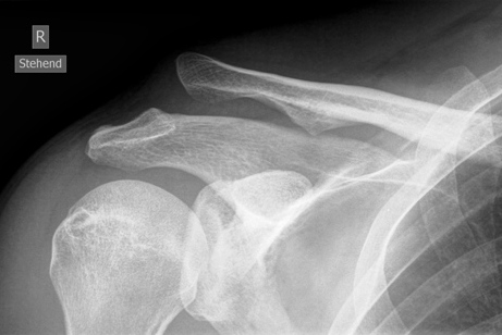 AC Luxation Typ Rockwood 3 vor Versorgung mit Balser Hakenplatte (Clavicular Hook Plate)